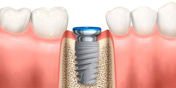 Implantes dentários